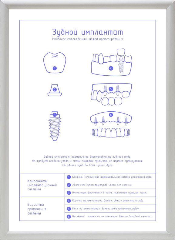 Схема импланта зуба