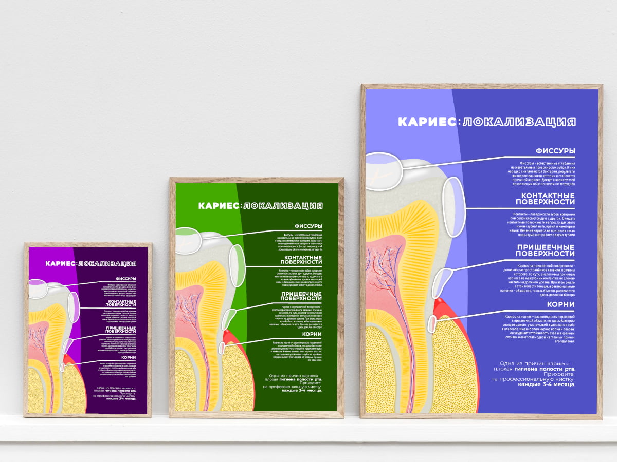 Плакат в стоматологию "Локализация кариеса" - цветовые решения